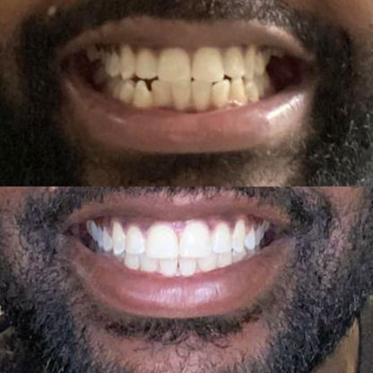 BRIGHTY™ Bandes blanchissantes