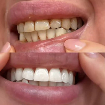 BRIGHTY™ Bandes blanchissantes